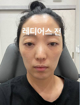40대 땅콩형 얼굴 레디어스 시술 전